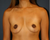 Feel Beautiful - Breast Lift 309 - After Photo
